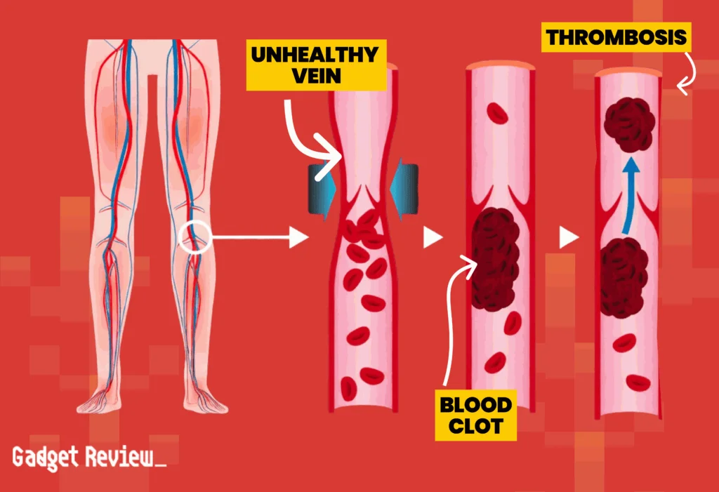 Anatomy of legs showing unhealthy veins, Blood Clot and Thrombosis