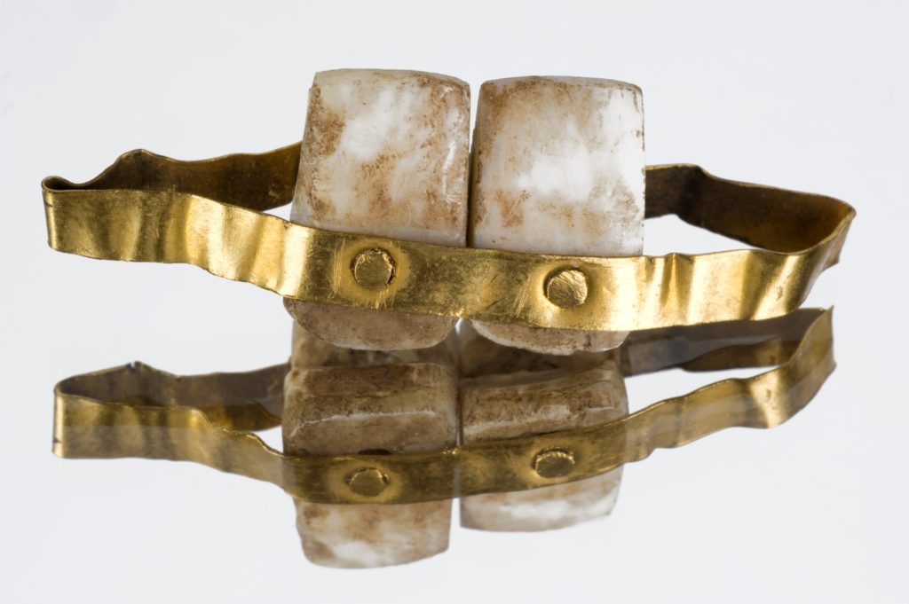 Etruscan Dental Bridges